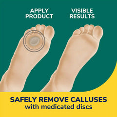 Extra Thick Callus Removers