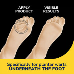 Plantar Wart Remover Seal & Heal Bandage with Hydrogel Technology