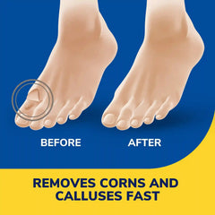 Liquid Corn & Callus Remover